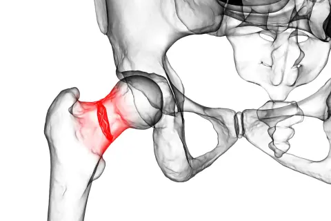 3D-Darstellung des menschlichen Beckens mit rot hervorgehobenem Oberschenkelhalsbruch, eine häufige Verletzung im Alter.