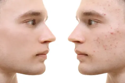 Gesichtsprofil links: reine Haut. Rechts: Akne-Ausbrüche, die durch Omega-3-Fettsäuren verbessert werden könnten.