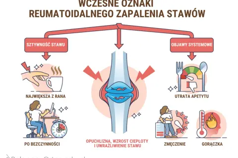Wczesne objawy reumatoidalnego zapalenia stawów: sztywność, opuchlizna, zmęczenie, gorączka, utrata apetytu.