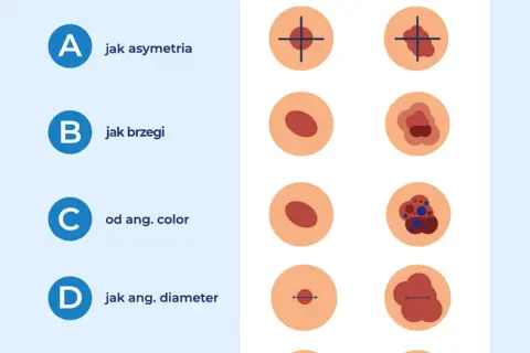Podejrzane znamię? Diagnostyka czerniaka w Polsce poradnik