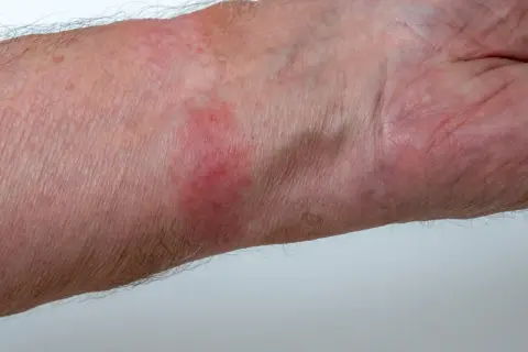 Pelle arrossata e irritata sul polso, sintomo di dermatite da contatto. Quanto dura? Dipende dalla causa.