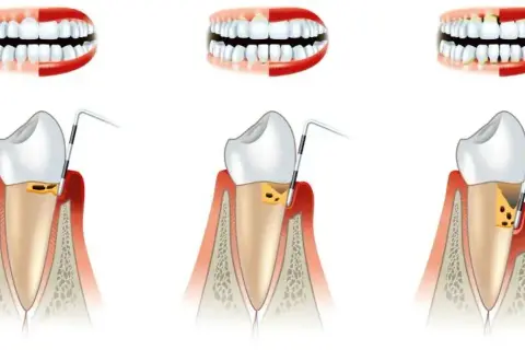 Periodontolog: Kiedy iść z dziąsłami? Przewodnik po specjalistach