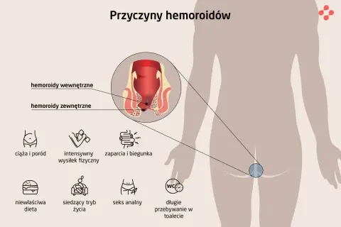Ilustracja pokazuje przyczyny hemoroidów: ciążę, wysiłek fizyczny, zaparcia, dietę, siedzący tryb życia, seks analny, długie przebywanie w toalecie. Hemoroidy wyleczyłam.