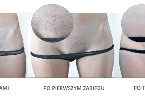 Depilacja laserowa bikini: przewodnik krok po kroku i efekty