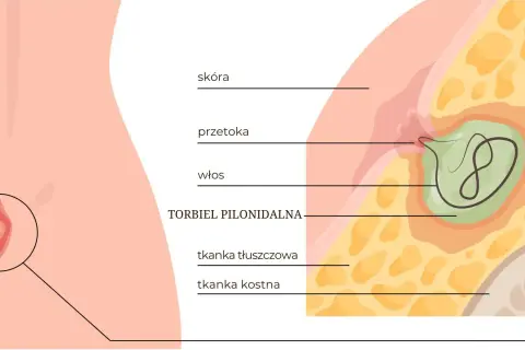 Przekrój skóry ukazujący torbiel pilonidalną z włosiem w środku, otoczoną tkanką tłuszczową i kostną.