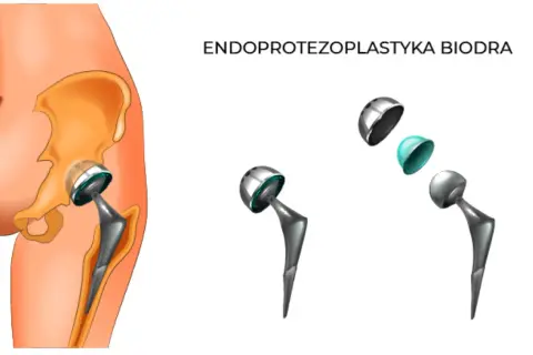 Schemat endoprotezy stawu biodrowego: implant w kości miednicy i kości udowej, oraz rozłożone elementy endoprotezy.