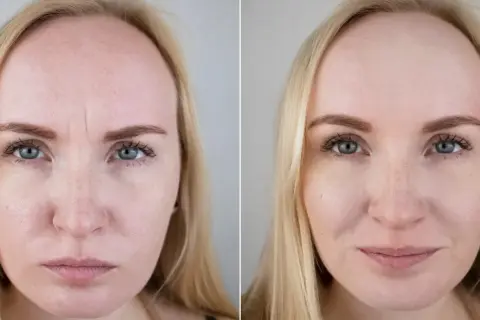 Mezoterapia mikroigłowa: efekty przed i po. Widoczne wygładzenie zmarszczek na czole i poprawa tekstury skóry.