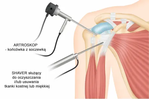 Artroskopia barku: artroskop i shaver pracują w obrębie stawu, lecząc uszkodzenia stożka rotatorów.