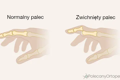 Skręcenie ręki: objawy, pierwsza pomoc i leczenie krok po kroku