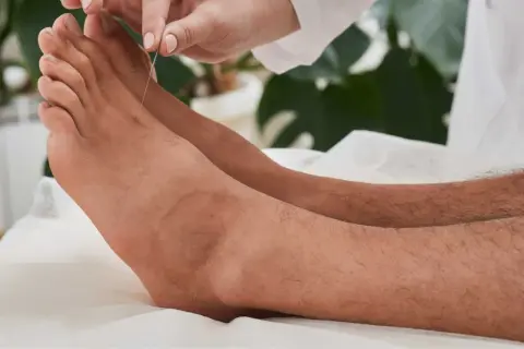 Acupuncture sur un pied, visant un point de pression pour un massage thérapeutique.