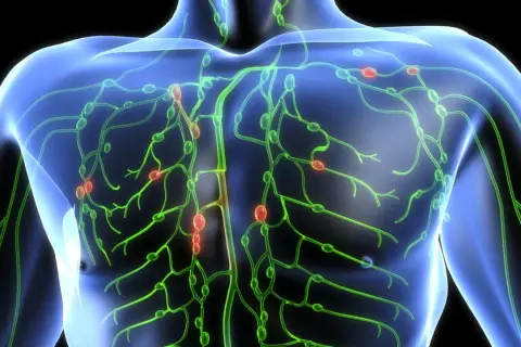 Das Lymphsystem des menschlichen Oberkörpers mit hervorgehobenen Lymphknoten. Dies kann helfen zu verstehen, was ein Lymphom ist.