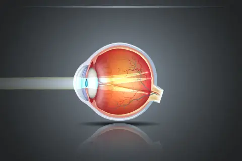 Astygmatyzm: Okulista czy Optometrysta? Sprawdź, kogo wybrać!