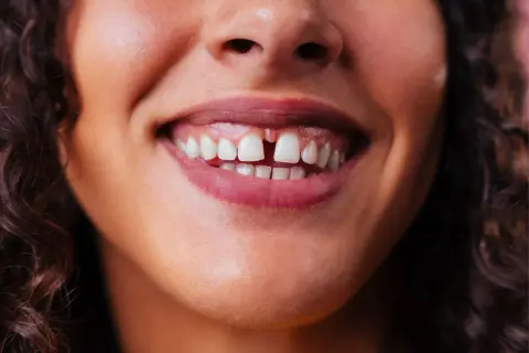 Uśmiechnięta twarz z widoczną diastemą, czyli przerwą między zębami. To naturalna cecha, która nadaje unikalny charakter.