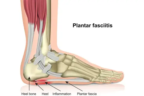 Anatomische Darstellung des Fußes, die zeigt, was ist plantarfasziitis: Entzündung der Plantarfaszie an der Ferse.