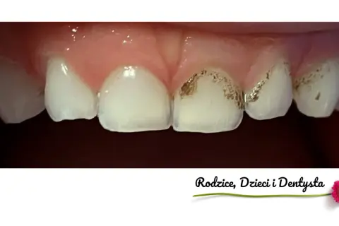 Zbliżenie na zęby dziecka z widocznymi przebarwieniami, które mogą wskazywać na próchnicę. Czarne zęby u dzieci to sygnał do wizyty u dentysty.