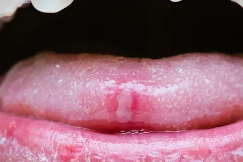 Nahaufnahme einer Zunge mit einer schmerzhaften Wunde, die auf einen Herpes zunge hindeutet. Die Lippen sind gerötet und gereizt.