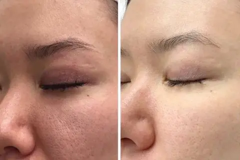 Vergleich: Haut mit großen Poren vor und nach der Anwendung von Retinol. Die Haut wirkt feiner und ebenmäßiger.
