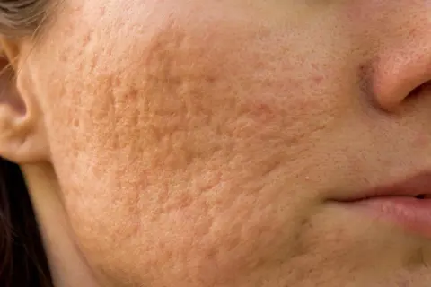 Gros plan sur une joue présentant une peau granuleuse et des cicatrices d'acné, révélant une texture irrégulière.
