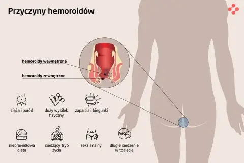 Hemoroidy? Przygotuj się do badania proktologicznego bez stresu!