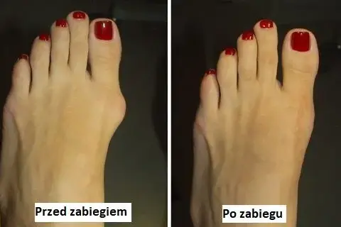 Operacja haluksa: Poznaj metody i odzyskaj stopę bez bólu