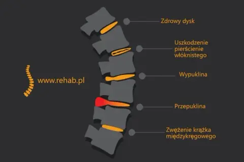 Skręcenie kręgosłupa lędźwiowego: objawy, przyczyny i co robić?
