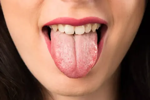 Boca abierta mostrando lengua rosada con pequeñas manchas rojas, reflejo de la ansiedad en la boca.