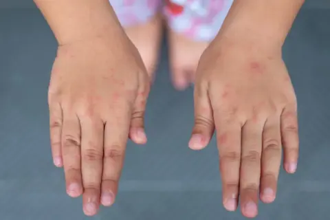 Czy cynamon uczula dzieci? Objawy alergii, które musisz znać