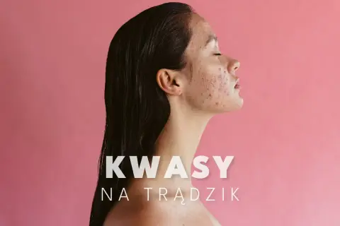 Kobieta z trądzikiem na twarzy, która odkrywa moc kwasów na trądzik.