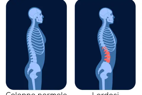 Confronto tra colonna vertebrale normale e colonna con lordosi accentuata. La cifosi non è visibile in questo confronto.