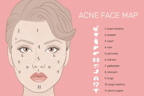 Mappa del viso per l'acne: la zona 3, intorno alla bocca, è collegata agli organi pelvici.
