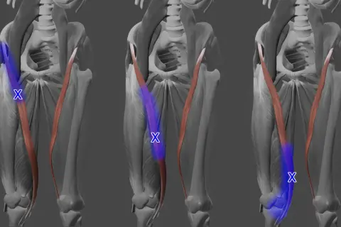 Musculus sartorius: Der Schneider-Muskel, hervorgehoben in Blau, verläuft diagonal über den Oberschenkel.