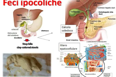 Feci ipocoliche, color argilla, dovute a ostruzione biliare. L'immagine mostra un diagramma del sistema biliare e un esempio di feci chiare.