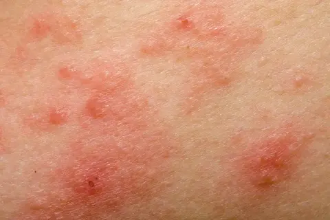 Skóra z zaczerwienionymi, swędzącymi zmianami, które mogą być objawem uczulenia na gluten.