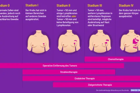 Brustkrebsstadien von 0 bis IV. Bei fortgeschrittenem aggressiver brustkrebs ist Chemotherapie eine Option.