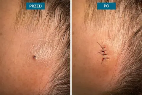 Przed i po zabiegu usuwania pieprzyka z twarzy. Widoczne blizny po chirurgicznym usunięciu zmiany.