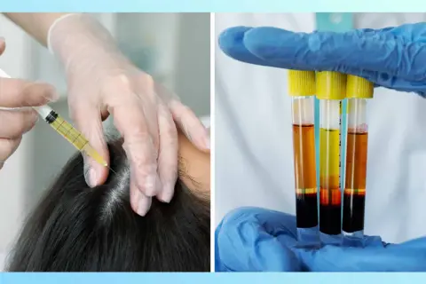Manos enguantadas aplicando mesoterapia capilar con jeringa y mostrando tubos de ensayo con plasma.