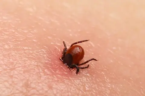 Zbliżenie na wbitego kleszcza na ludzkiej skórze. Pajęczak z ośmioma odnóżami wgryza się w naskórek, widoczny jest zaczerwieniony obszar wokół niego.