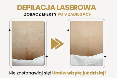 Depilacja: Czy znasz różnicę? Wybierz idealną metodę!