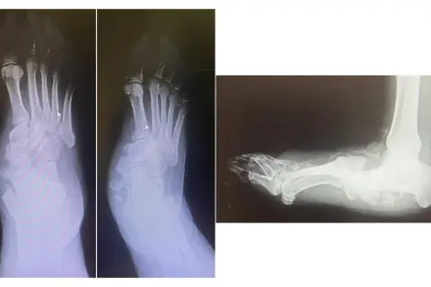 Radiografie del piede con deformità tipica del piede di Charcot, in preparazione per un intervento chirurgico.