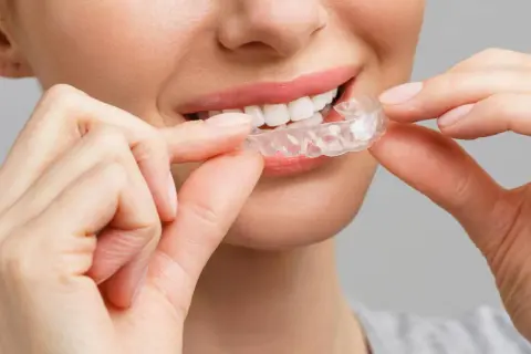 Sorriso smagliante con clear aligners. La donna sorride mentre applica gli apparecchi trasparenti per un sorriso perfetto.