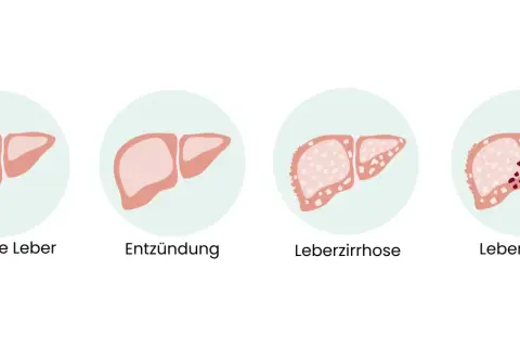 Illustration zeigt gesunde Leber, Entzündung, Leberzirrhose und Leberkrebs. Frühe Anzeichen von Leberkrebs sind oft unspezifisch.