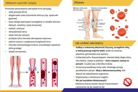 Jak zapobiec zakrzepicy? 4 filary dla zdrowych żył. Sprawdź ryzyko!