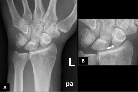 Radiografie del polso. L'immagine B evidenzia un aumento dello spazio tra radio e ulna, indicativo di lesione del legamento triangolare polso.