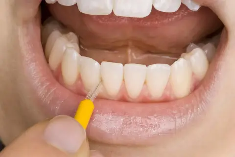 Un primo piano di denti bianchi e gengive sane, con un piccolo scovolino giallo che pulisce tra gli incisivi. La domanda è: il filo interdentale si passa prima o dopo lo spazzolino?