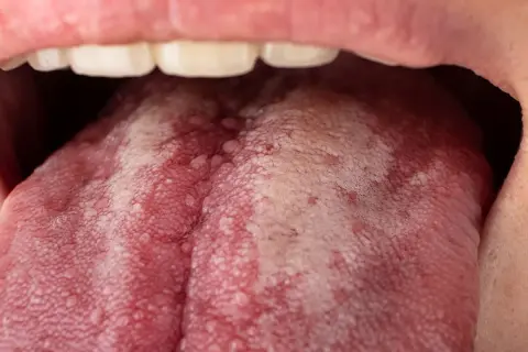 Lengua con una llaga roja y parches blancos, mostrando papilas inflamadas y pequeñas protuberancias.