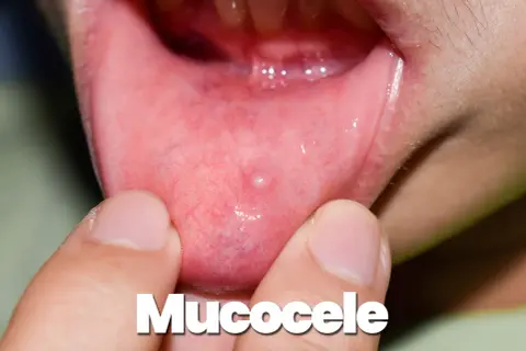 Piccolo mucocele, una cisti da ritenzione, appare sulla mucosa interna della bocca, evidenziata da dita.