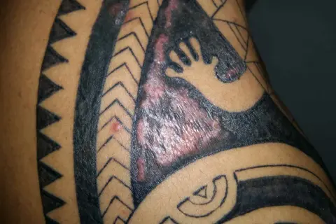 Gros plan sur un tatouage tribal qui gratte, avec des zones rouges et enflammées sur la peau.
