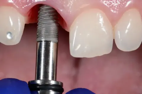 Zabieg wszczepienia implantu dentystycznego w szczękę. Widoczne narzędzie stomatologiczne i fragment implantu.