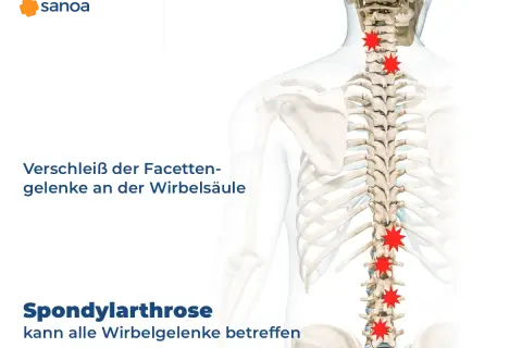 Spondylose mit Radikulopathie: Verschleiß der Facettengelenke an der Wirbelsäule, rot markierte Schmerzpunkte.