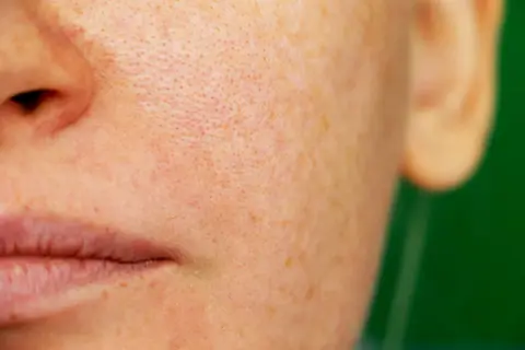 Primer plano de piel con poros visibles y manchas de melasma facial.